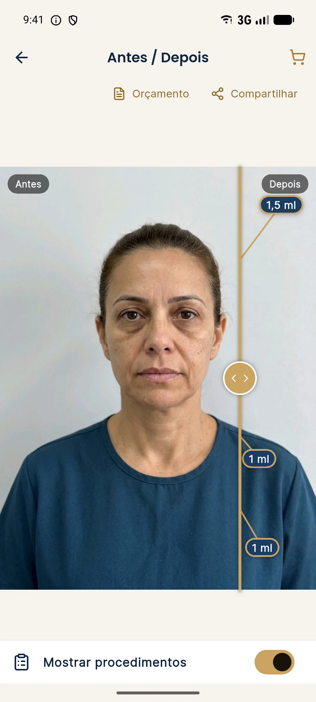 Slider de Antes e Depois do Harmy com a linha dourada deslocada para a direita e rótulos de volume em ml sobre o lado Depois