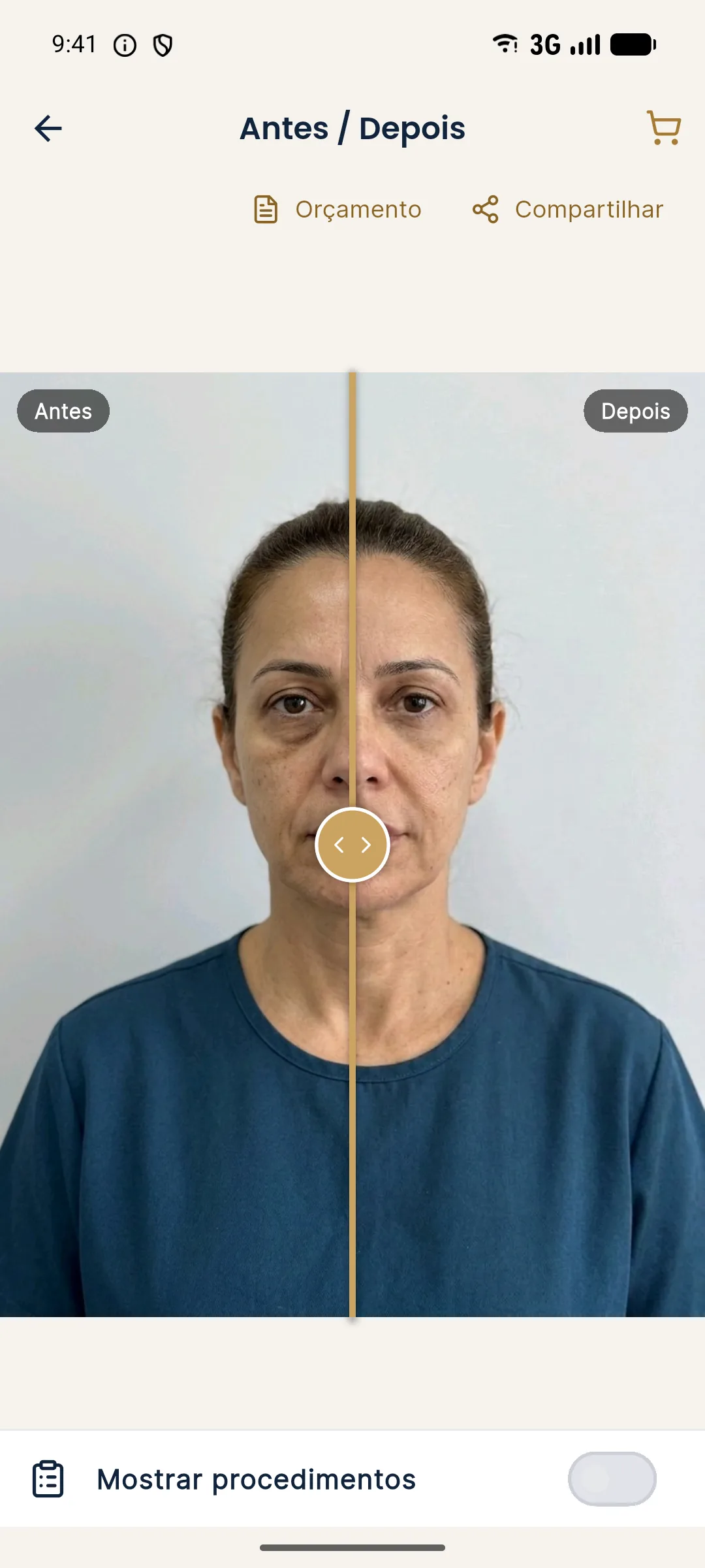 Tela Antes e Depois do Harmy com a linha dourada no centro da foto, rótulos Antes e Depois e os botões Orçamento e Compartilhar