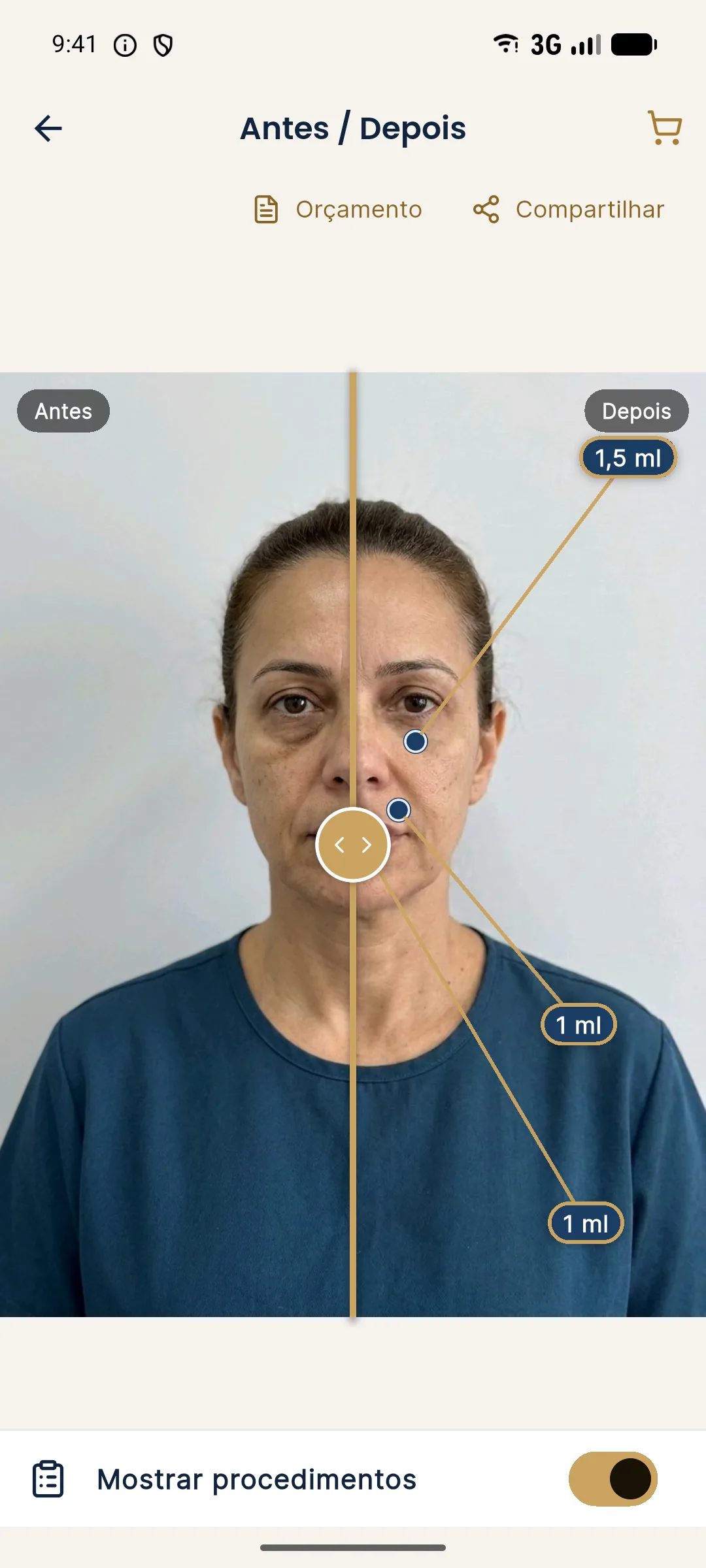 Antes e Depois do Harmy com Mostrar procedimentos ligado, pontos nas regiões tratadas e rótulos de 1,5 ml, 1 ml e 1 ml
