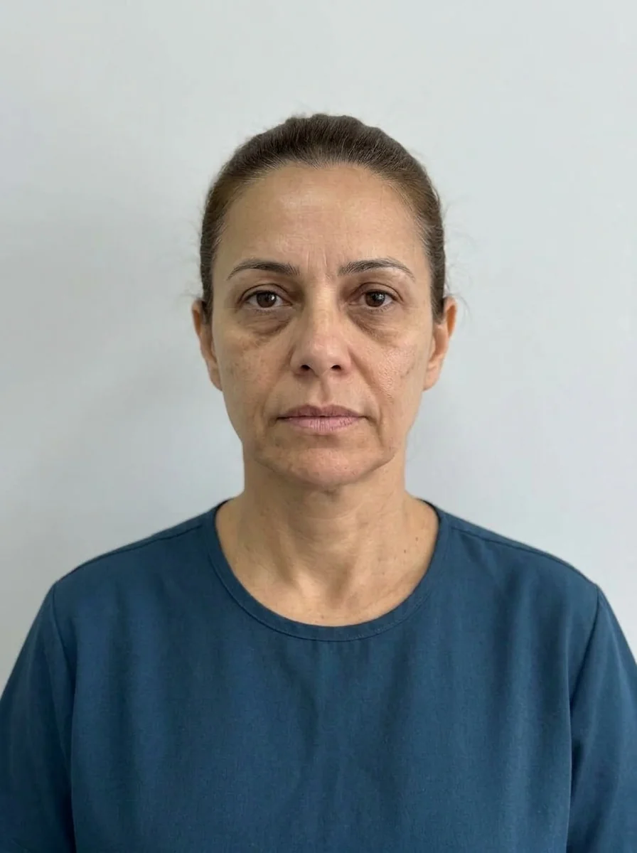 Simulação gerada no Harmy para preenchimento zigomático (arco zigomático) com ácido hialurônico