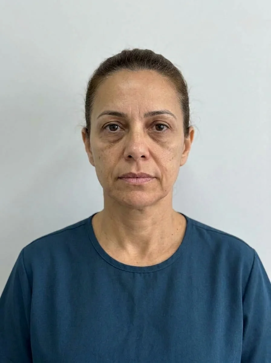 Simulação gerada no Harmy para preenchimento de têmporas com ácido hialurônico